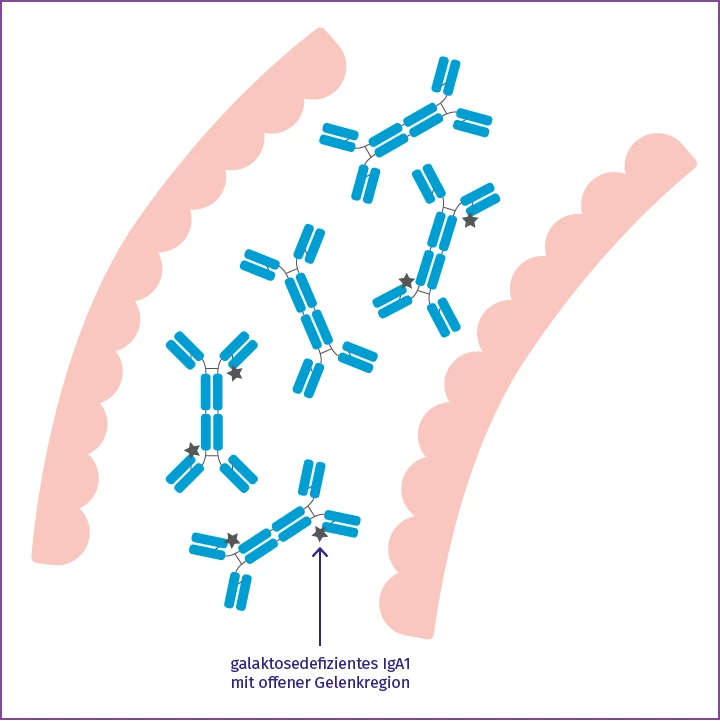 Abbildung: galaktosedefizientes IgA1 mit offener Gelenkregion