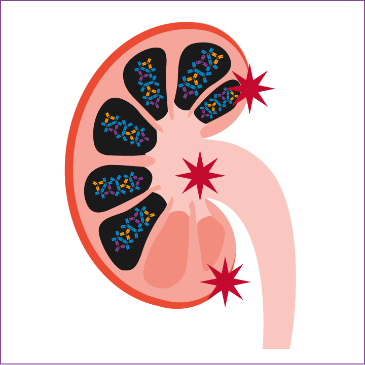 Abbildung einer Niere und den Risikofaktoren für terminale Niereninsuffizienz